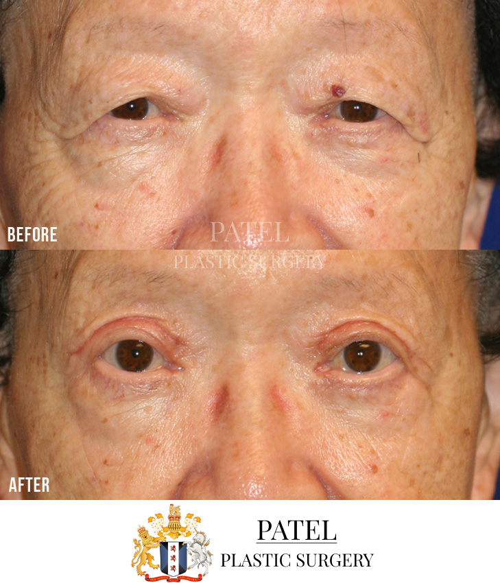 Eastern Eyelids Patient 17