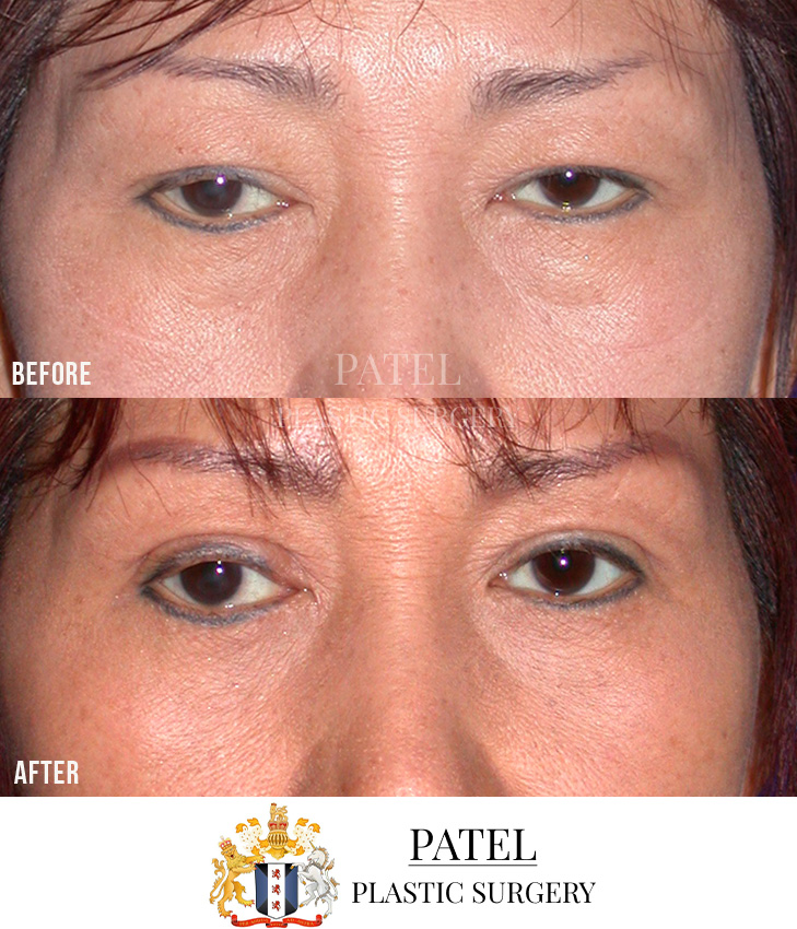 Eastern Eyelids Patient 18