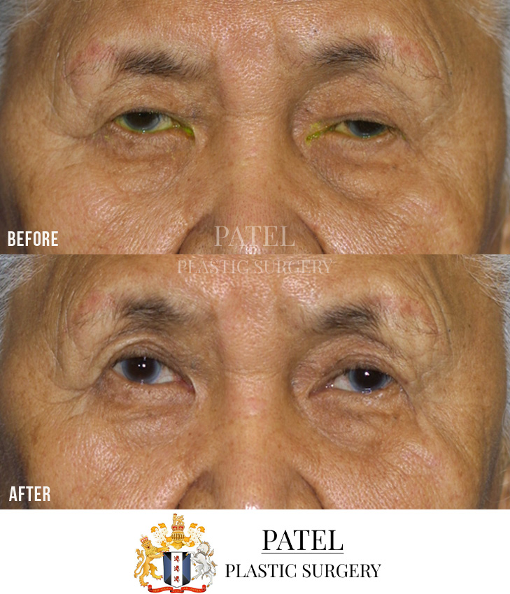 Eastern Eyelids Patient 19