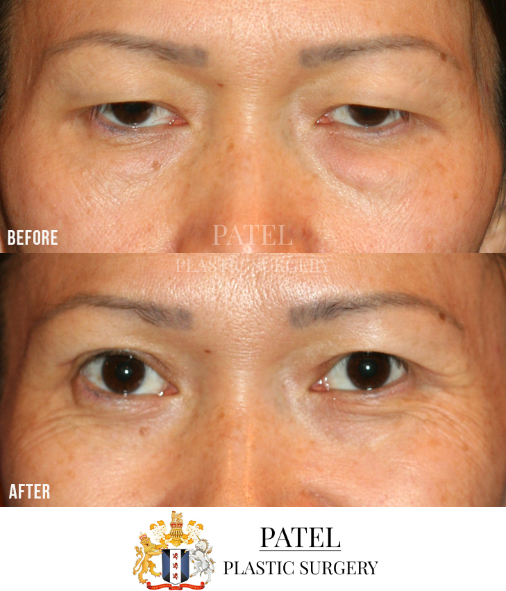 Eastern Eyelids Patient 2