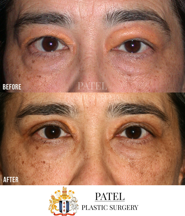 Eastern Eyelids Patient 20 Front View
