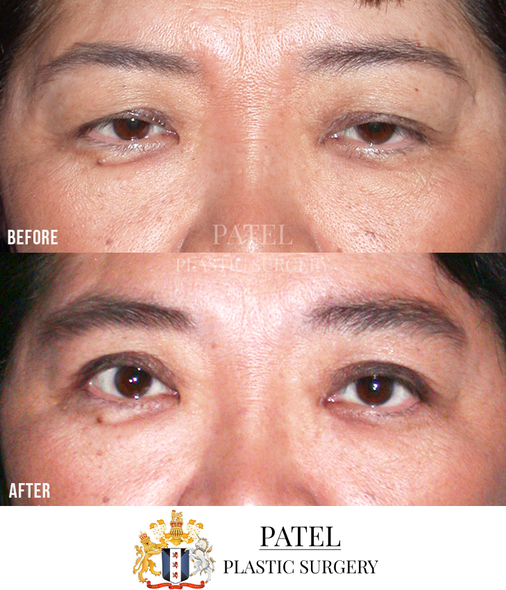 Eastern Eyelids Patient 3