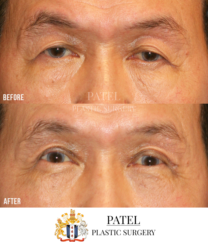 Eastern Eyelids Patient 4