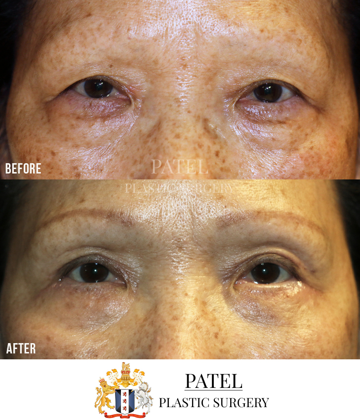 Eastern Eyelids Patient 5