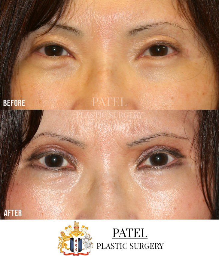 Eastern Eyelids Patient 6