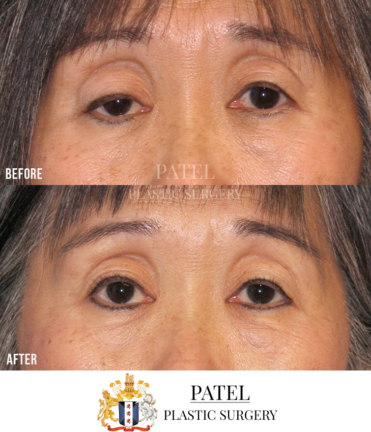 Eastern Eyelids Patient 7