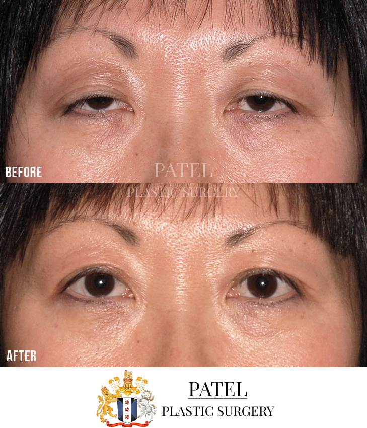 Eastern Eyelids Patient 8
