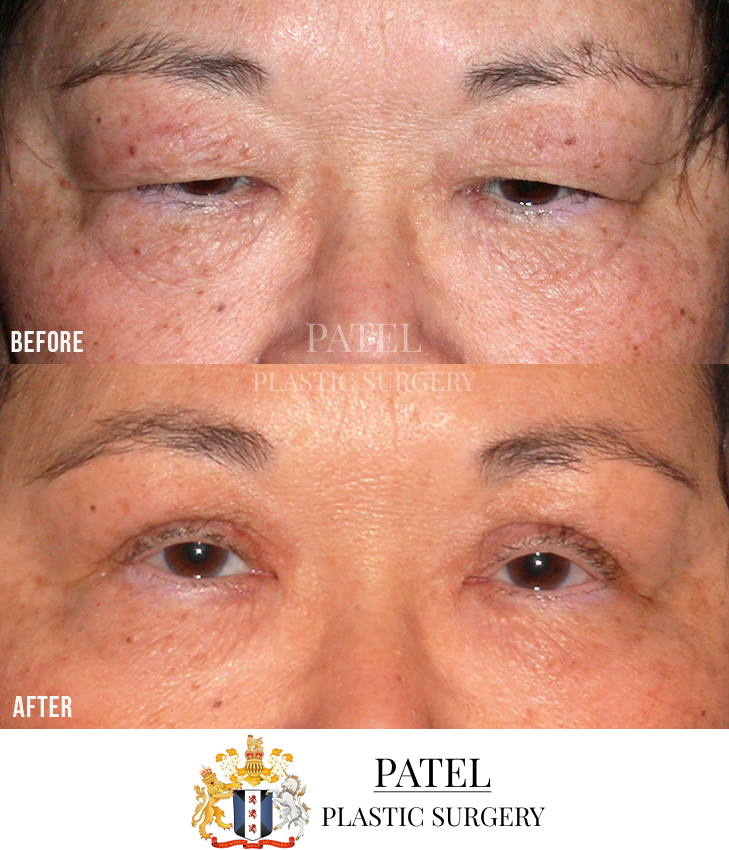 Eastern Eyelids Patient 9
