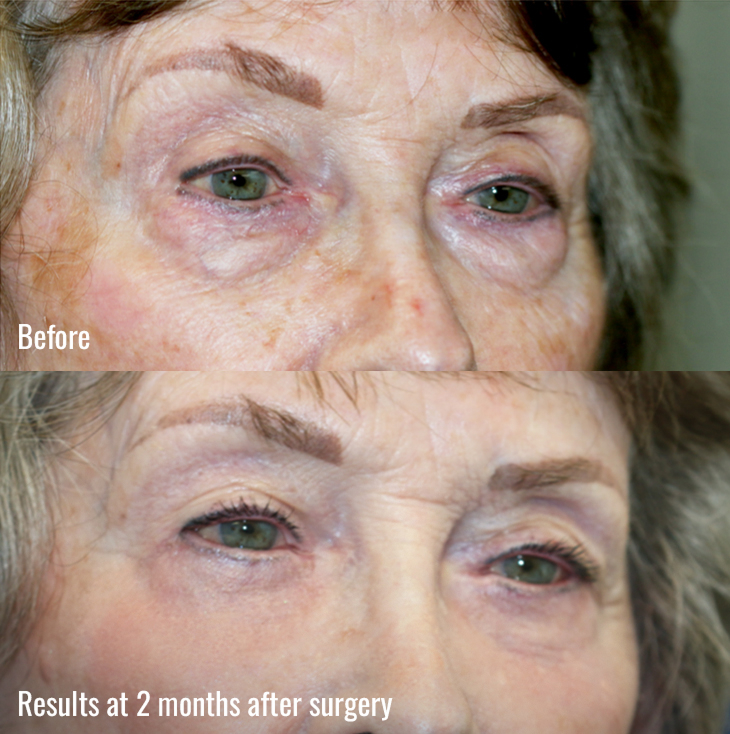 2 months after surgery image of Lower Eyelids