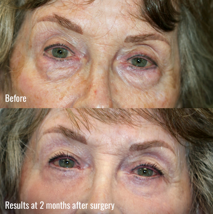2 months surgery image of Lower Eyelids