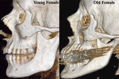 Aging of the Bones and its effect on the lower eyelids
