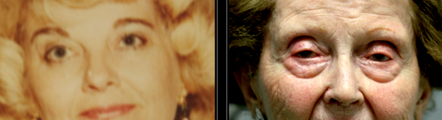 Aging of the lower eyelids and cheeks