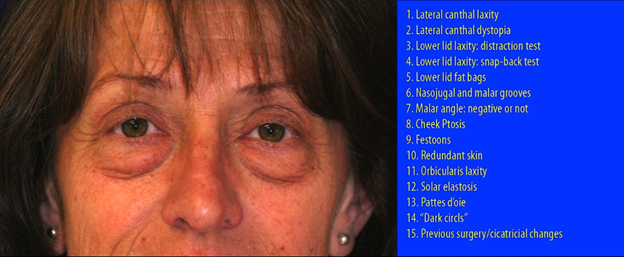 Assessment of the Aging Lower eyelids