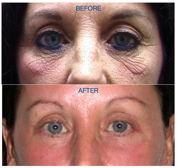 Before & After in a Caucasian with Fitzpatrick type 3 skin