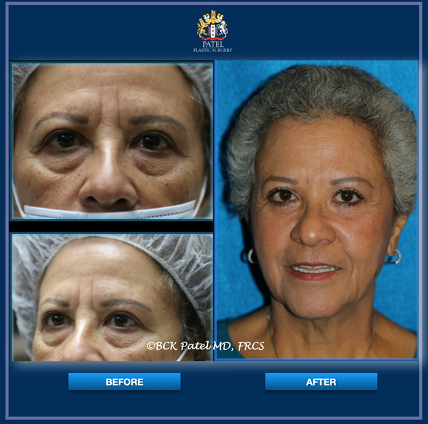 Before & After in a Latina Female