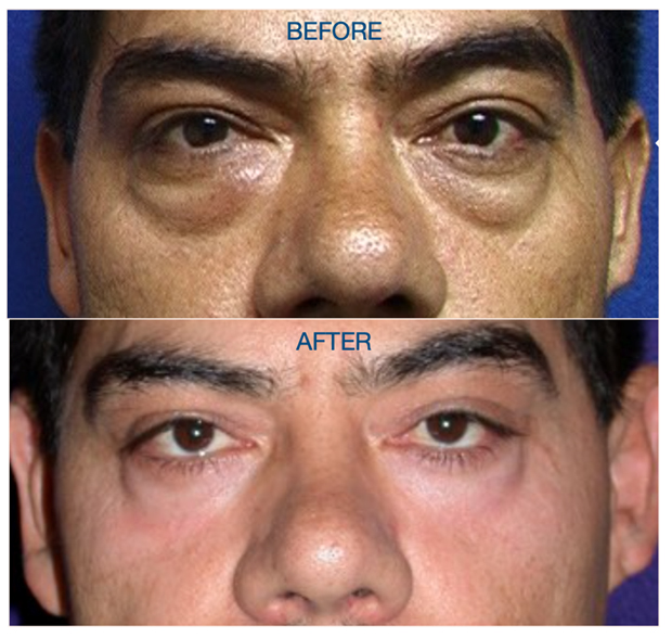 Before & After in a Latina Male