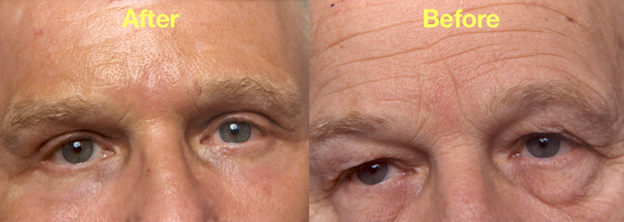 Before & After in a Male who underwend the full Hammock Lift