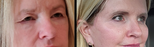 Before and After image of Hammock Lift