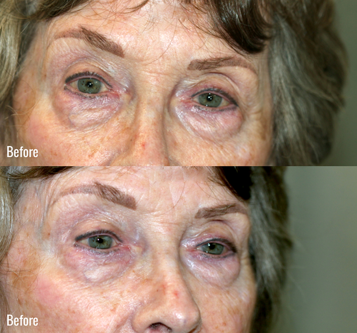 Before image of Lower Eyelids