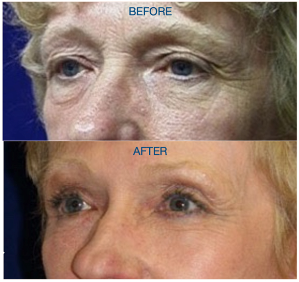 Hammock Lift in a patient with Fitzpatrick type 1 skin
