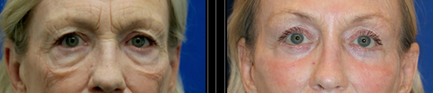 Lower Blepharoplasty and Cheek Lifts with volume augmenation and treatment of fat, skin, grooves, fat pads