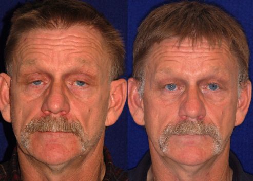 herrman-floyd-pre-post-slings_orig