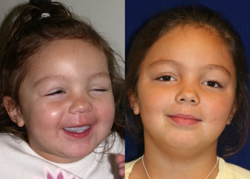 holland-temia-pre-post_orig