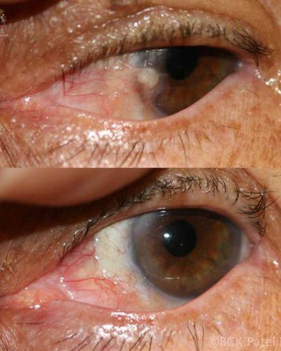 This patient's pterygium had been resected three times previously with repeated recurrences. He presented to us with a fibrous nodule on the cornea