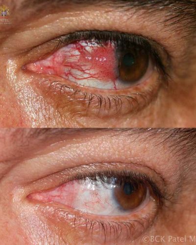 A large carcinoma-in-situ imitating a pterygium with large feeder vessels: treatment was with resection, cryotherapy and a large conjunctival graft with careful followup.