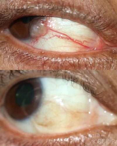 Another carcinoma-in-situ masquerading as a pterygium