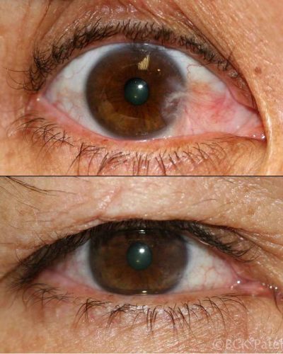 Many patients present with a "dry, uncomfortable eye which is red all the time." Treatment improves all of these symptoms to varying degrees