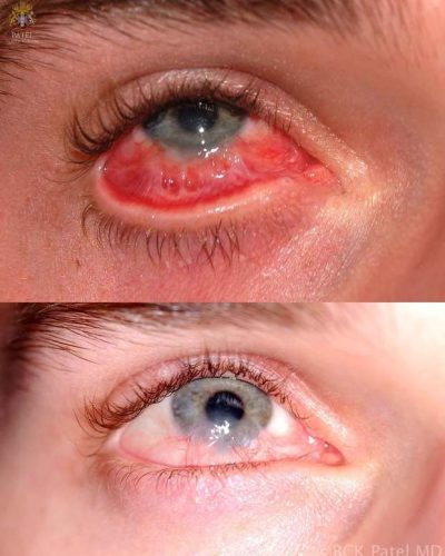 This is extensive symblepharon and loss of limbal stem cells from a chemical burn. Extensive mucous membrane grafts are needed, sometimes over several treatments to improve this condition. The limbal stem cell loss from the chemical burn means that there will always be ingrowth of fibrovascular tissue, unless the stem cells are repopulated with stem cell grafts