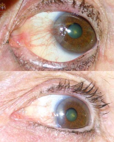 A more typical "low-grade" pterygium with a good result after resection and grafting