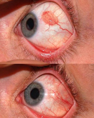 This was sent to us as a pingueculum but is actually a carcinoma in situ. Treatment involved resection, cryotherapy and a free conjunctival graft