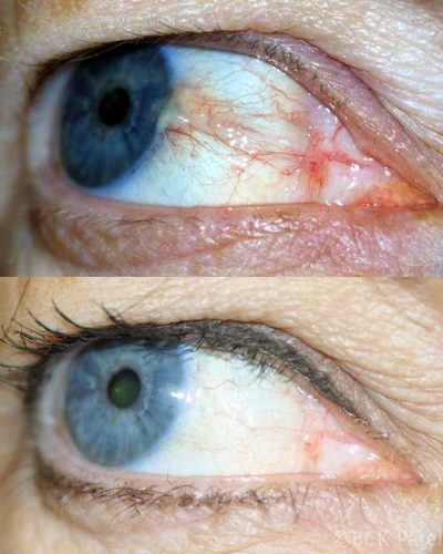 A sign of a long-standing pterygium is the thickened, raised, yellowish deposits seen within the head of the pterygium