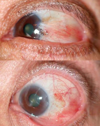 Although most pterygia are medial, we frequently see "double pterygia" meaning growths on the medial and lateral sides of the cornea and sometimes growths just on the lateral side