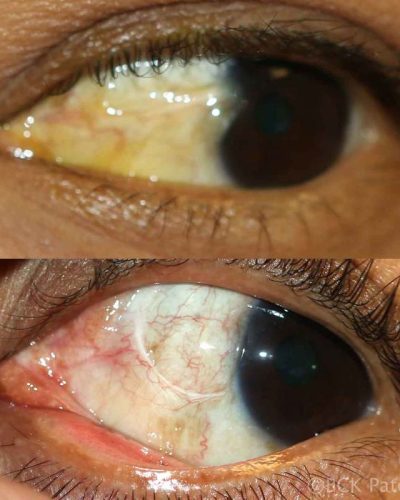 Sometimes, the edge of the conjunctival graft will form a crescent of fibrous tissue. This is not a bad thing as it almost always prevents ingrowth of any further fibrovascular tissue from the area of the caruncle