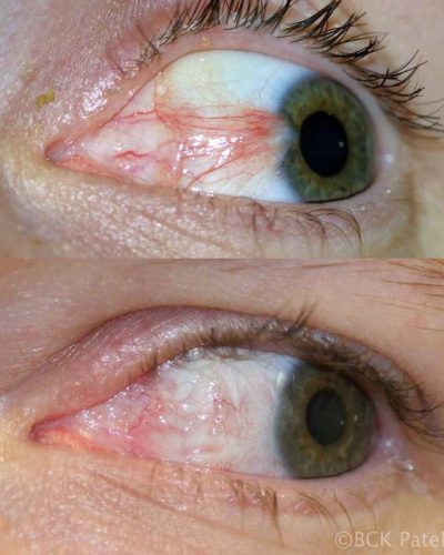 A ore fibrovascular pterygium which needed more aggressive resection of the base of the pterygium