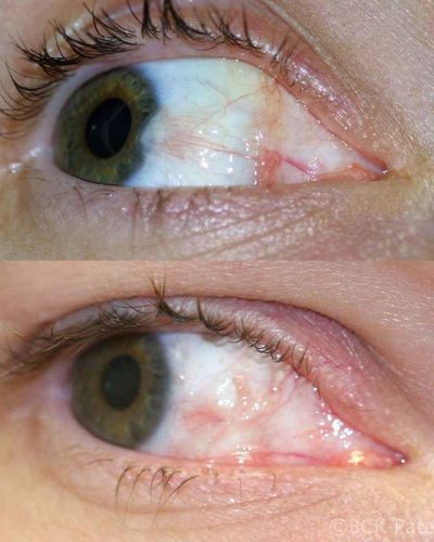 A typical pterygium with mild residual pinkness after surgery: this is normal